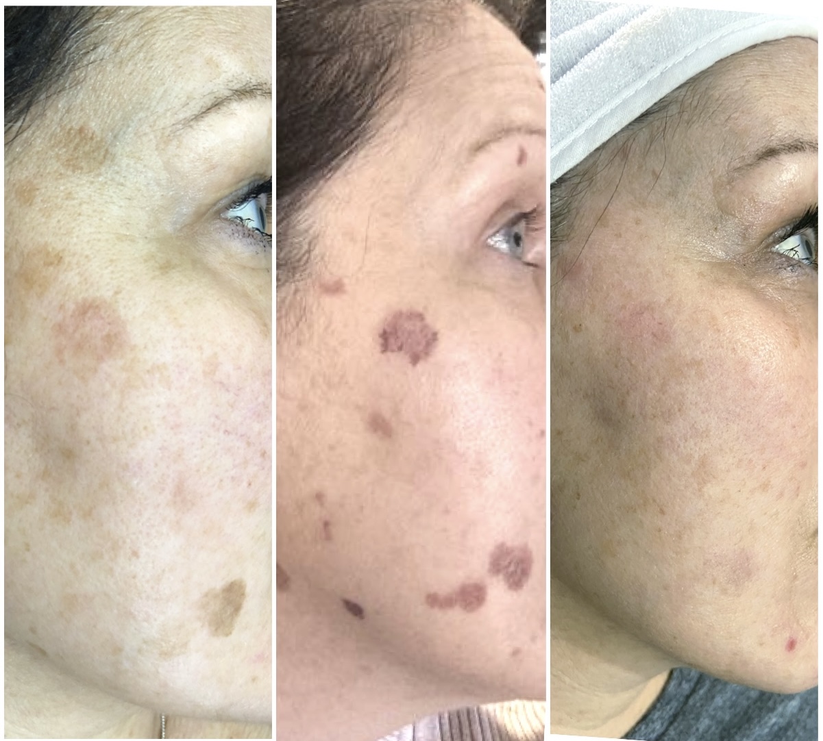After-laser-on-face